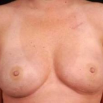Immediate Breast Reconstruction - Nipple Sparing - Case #8 After