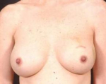 Immediate Breast Reconstruction - Nipple Sparing - Case #9 Before