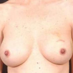 Immediate Breast Reconstruction - Nipple Sparing - Case #9 Before