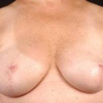 Immediate Breast Reconstruction - Nipple Sparing - Case #10 After