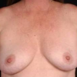Immediate Breast Reconstruction - Nipple Sparing - Case #11 Before