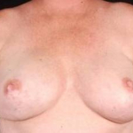 Immediate Breast Reconstruction - Nipple Sparing - Case #11 After