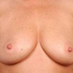 Immediate Breast Reconstruction - Nipple Sparing - Case #12 Before