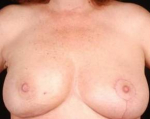 Immediate Breast Reconstruction - Nipple Sparing - Case #12 After