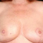 Immediate Breast Reconstruction - Nipple Sparing - Case #12 After