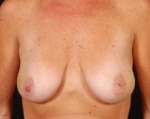 Immediate Breast Reconstruction - Nipple Sparing - Case #13 Before