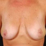Immediate Breast Reconstruction - Nipple Sparing - Case #13 Before