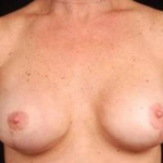 Immediate Breast Reconstruction - Nipple Sparing - Case #13 After
