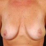 Immediate Breast Reconstruction - Nipple Sparing - Case #14 Before