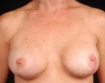 Immediate Breast Reconstruction - Nipple Sparing - Case #14 After