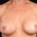 Immediate Breast Reconstruction - Nipple Sparing - Case #14 After