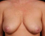 Immediate Breast Reconstruction - Nipple Sparing - Case #15 Before