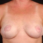 Immediate Breast Reconstruction - Nipple Sparing - Case #15 After