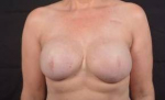 Immediate Breast Reconstruction - Skin Sparring - Case #24 After