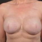 Immediate Breast Reconstruction - Skin Sparring - Case #24 After