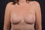 Immediate Breast Reconstruction - Skin Sparring - Case #22 After