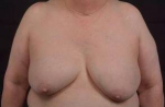 Breast Augmentation Mastopexy - Case #34 Before