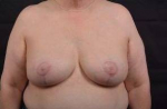Breast Augmentation Mastopexy - Case #34 After