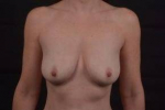 Breast Augmentation Mastopexy - Case #29 Before