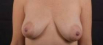 Breast Augmentation Mastopexy - Case #27 Before