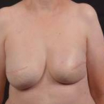 Immediate Breast Reconstruction - Skin Sparring - Case #11 After