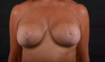 Breast Augmentation Mastopexy - Case #13 After
