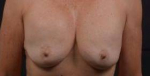 Breast Augmentation Mastopexy - Case #12 Before