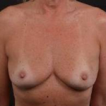Immediate Breast Reconstruction - Skin Sparring - Case #23 Before