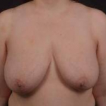 Immediate Breast Reconstruction - Skin Sparring - Case #21 Before