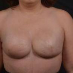 Immediate Breast Reconstruction - Skin Sparring - Case #21 After