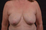 Immediate Breast Reconstruction - Skin Sparring - Case #19 Before