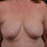 Immediate Breast Reconstruction - Skin Sparring - Case #19 Before