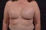 Immediate Breast Reconstruction - Skin Sparring - Case #19 After