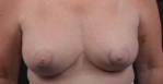 Mastopexy Augmentation - Case #21a After