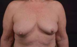 Immediate Breast Reconstruction - Skin Sparring - Case #17 Before