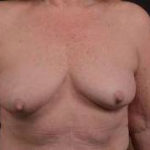 Immediate Breast Reconstruction - Skin Sparring - Case #17 Before