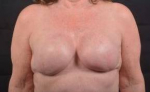 Immediate Breast Reconstruction - Skin Sparring - Case #17 After