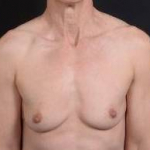 Immediate Breast Reconstruction - Skin Sparring - Case #21A Before