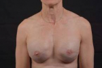 Immediate Breast Reconstruction - Skin Sparring - Case #21A After
