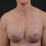 Immediate Breast Reconstruction - Skin Sparring - Case #21A After