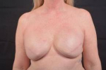 Delayed Breast Reconstruction - Case #9 After