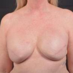 Delayed Breast Reconstruction - Case #9 After