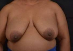 Immediate Breast Reconstruction - Skin Sparring - Case #12 Before
