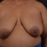 Immediate Breast Reconstruction - Skin Sparring - Case #12 Before