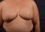 Immediate Breast Reconstruction - Skin Sparring - Case #12 After