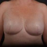 Immediate Breast Reconstruction - Skin Sparring - Case #5 After