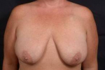 Immediate Breast Reconstruction - Skin Sparring - Case #4 Before