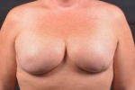 Immediate Breast Reconstruction - Skin Sparring - Case #4 After