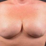 Immediate Breast Reconstruction - Skin Sparring - Case #4 After