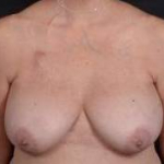 Immediate Breast Reconstruction - Skin Sparring - Case #3 Before